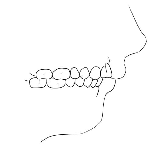 articule dentaire machoire du bas en arriere chirurgie orthognatique docteur paul moulin chirurgien maxillo facial paris articule dentaire machoire du bas en arriere chirurgie orthognatique docteur paul moulin chirurgien maxillo facial paris