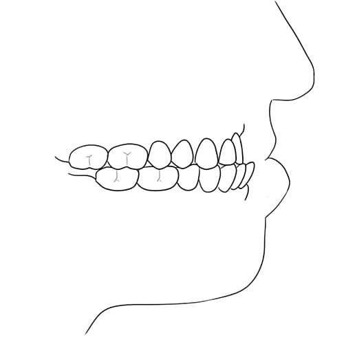 articule dentaire machoire du haut en arriere chirurgie orthognatique docteur paul moulin chirurgien maxillo facial paris