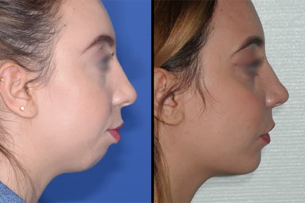 chirurgie maxillo facial changement visage chirurgie orthognatique avant apres docteur paul moulin chirurgien maxillo facial paris