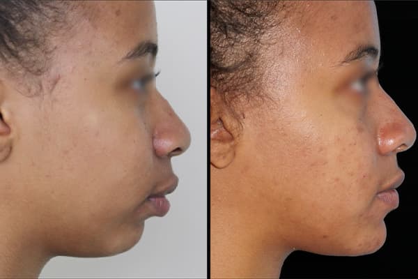 chirurgie maxillo facial combien de temps pour degonfler chirurgie orthognatique avant apres docteur paul moulin chirurgien maxillo facial paris