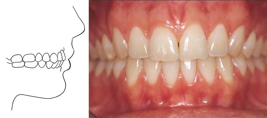 photo articule dentaire normal chirurgie orthognatique docteur paul moulin chirurgien maxillo facial paris