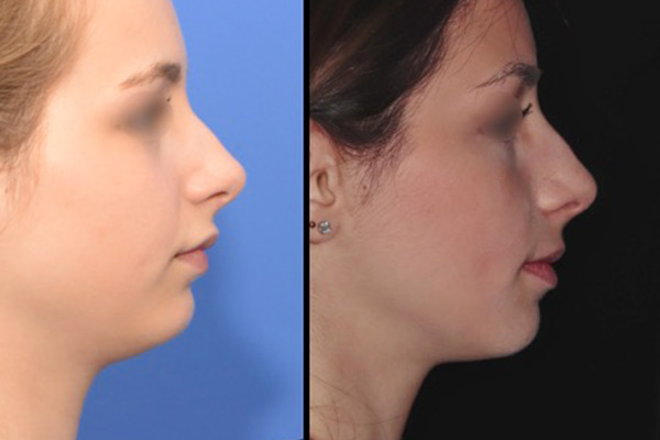 chirurgie de la mandibule dr paul moulin chirurgien maxillo facial specialiste chirurgie orthognatique rhinoplastie paris