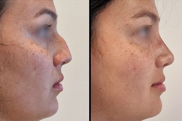 chirurgie esthetique du nez preservation rhinoplasty dr paul moulin chirurgien maxillo facial specialiste chirurgie orthognatique rhinoplastie paris