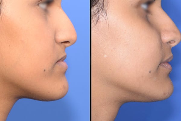 chirurgie maxillo facial avant apres dr paul moulin chirurgien maxillo facial specialiste chirurgie orthognatique rhinoplastie paris