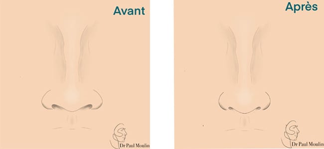 chirurgie narines docteur paul moulin chirurgien maxillo facial specialiste chirurgie orthognatique rhinoplastie paris