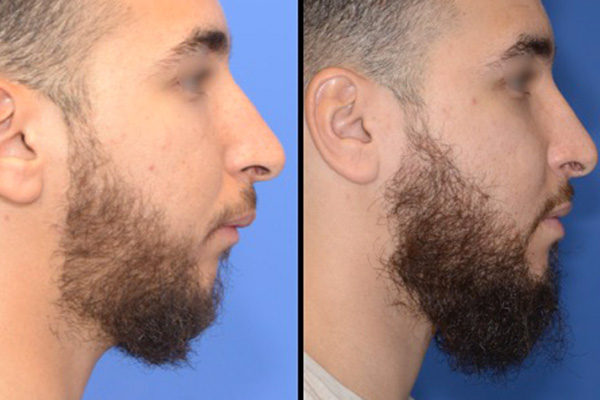 chirurgie osteotomie mandibulaire dr paul moulin chirurgien maxillo facial specialiste chirurgie orthognatique rhinoplastie paris