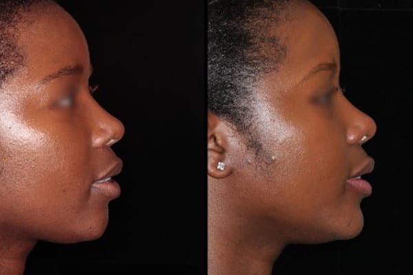 genioplastie menton fuyant docteur paul moulin chirurgien maxillo facial specialiste chirurgie orthognatique rhinoplastie paris