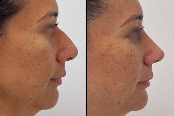 nez avec bosse rhinoplastie preservatrice dr paul moulin chirurgien maxillo facial specialiste chirurgie orthognatique rhinoplastie paris