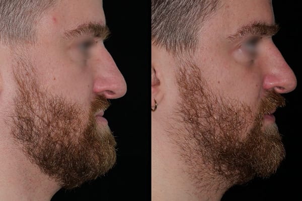 operation maxillo facial dr paul moulin chirurgien maxillo facial specialiste chirurgie orthognatique rhinoplastie paris