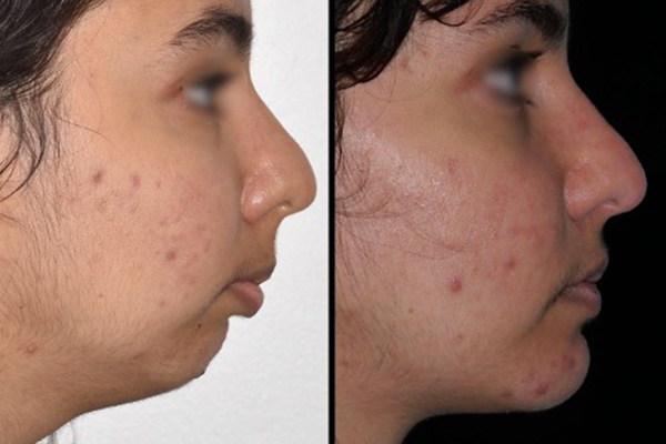 osteotomie mandibulaire d avancement dr paul moulin chirurgien maxillo facial specialiste chirurgie orthognatique rhinoplastie paris