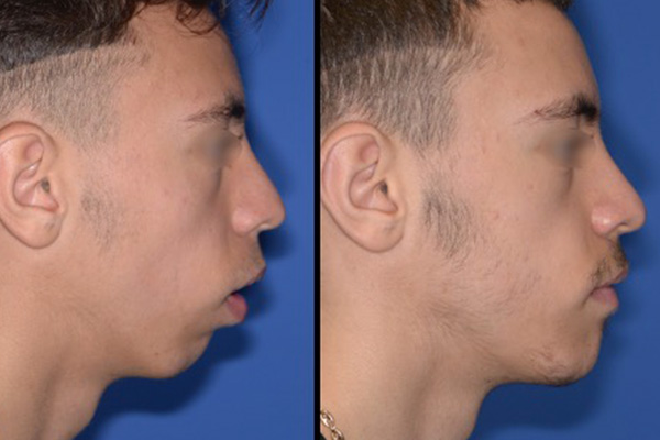 osteotomie mandibulaire post operatoire dr paul moulin chirurgien maxillo facial specialiste chirurgie orthognatique rhinoplastie paris