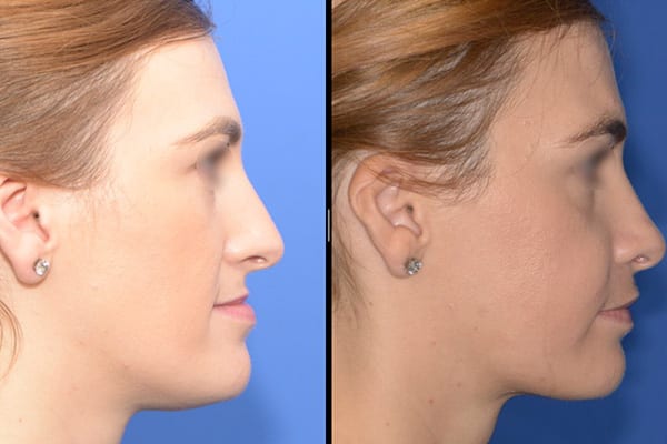 osteotomie maxillaire d abaissement dr paul moulin chirurgien maxillo facial specialiste chirurgie orthognatique rhinoplastie paris