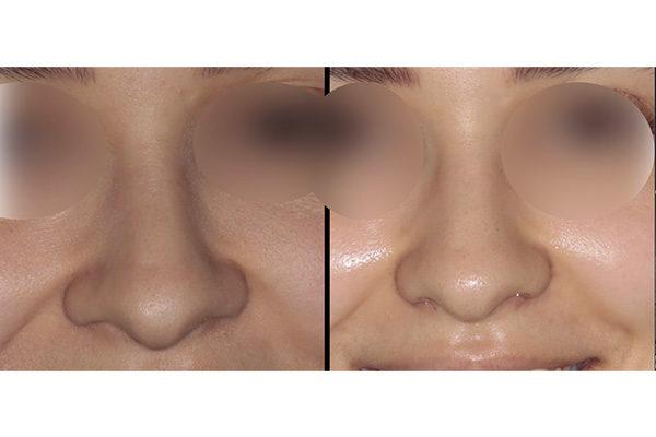 rhinoplastie ailes du nez dr paul moulin chirurgien maxillo facial specialiste chirurgie orthognatique rhinoplastie paris