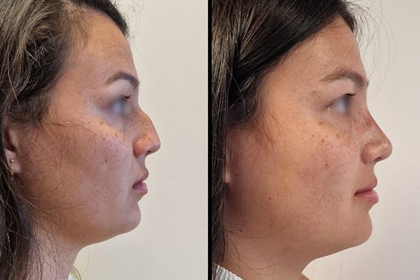 rhinoplastie avant apres dr paul moulin chirurgien maxillo facial specialiste chirurgie orthognatique rhinoplastie paris