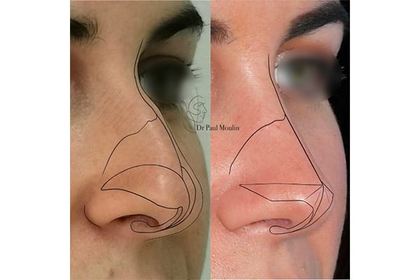 rhinoplastie de pointe dr paul moulin chirurgien maxillo facial specialiste chirurgie orthognatique rhinoplastie paris