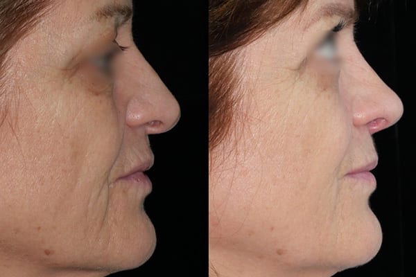 rhinoplastie de preservation petite bosse sur le nez dr paul moulin chirurgien maxillo facial specialiste chirurgie orthognatique rhinoplastie paris