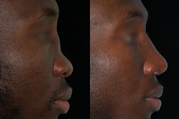 rhinoplastie ethnique c est quoi dr paul moulin chirurgien maxillo facial specialiste chirurgie orthognatique rhinoplastie paris