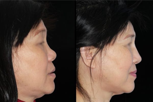 rhinoplastie ethnique prix dr paul moulin chirurgien maxillo facial specialiste chirurgie orthognatique rhinoplastie paris