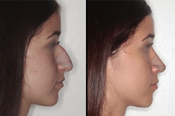 rhinoplastie jour apres jour dr paul moulin chirurgien maxillo facial specialiste chirurgie orthognatique rhinoplastie paris