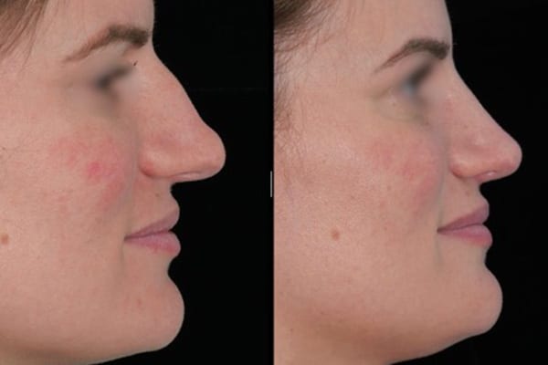 rhinoplastie ultrasonique anesthesie locale dr paul moulin chirurgien maxillo facial specialiste chirurgie orthognatique rhinoplastie paris