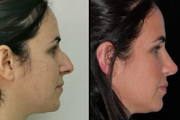 rhinoplastie ultrasonique avant apres dr paul moulin chirurgien maxillo facial specialiste chirurgie orthognatique rhinoplastie paris