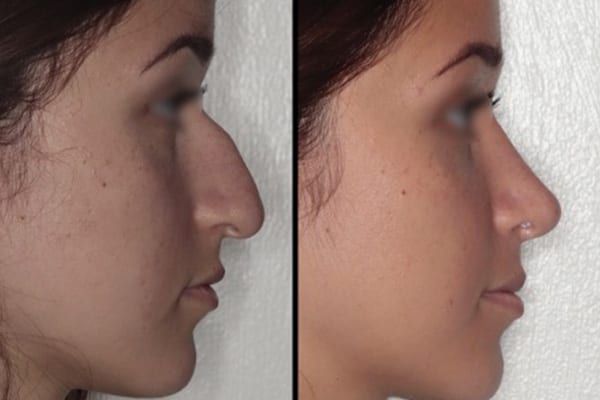 rhinoplastie ultrasonique avantages dr paul moulin chirurgien maxillo facial specialiste chirurgie orthognatique rhinoplastie paris