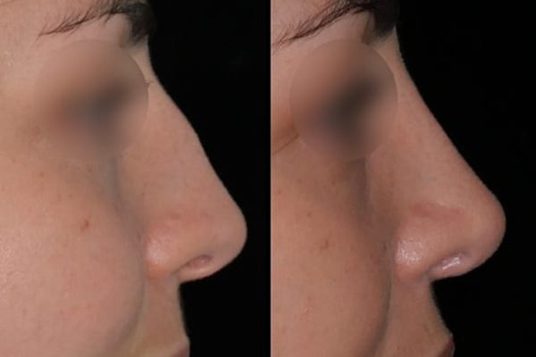 rhinoplastie ultrasonique prix dr paul moulin chirurgien maxillo facial specialiste chirurgie orthognatique rhinoplastie paris
